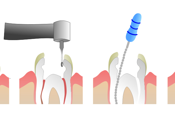 Root canals